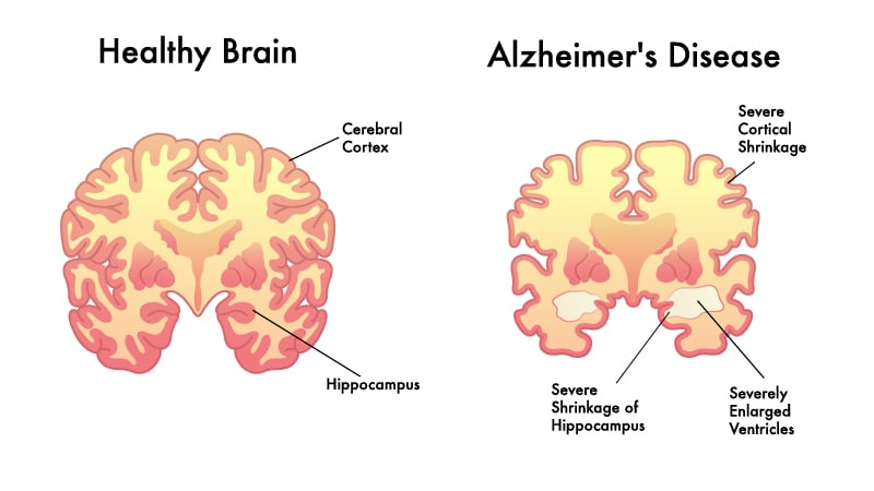 Illustration of healthy human brain and alzheimer disease on white background